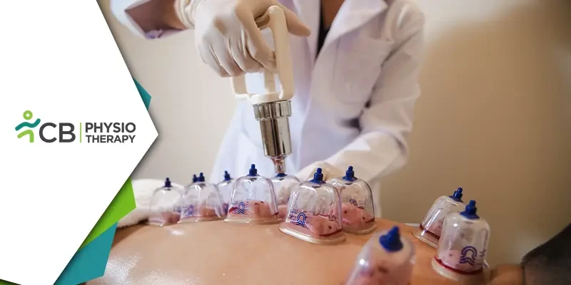 Cupping Therapy(hijama) | Unlocking Health Benefits In Physiotherapy