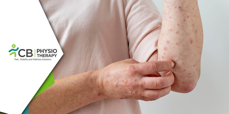 Physiotherapy In Leprosy | A Guide To Help People With Injury And Disability